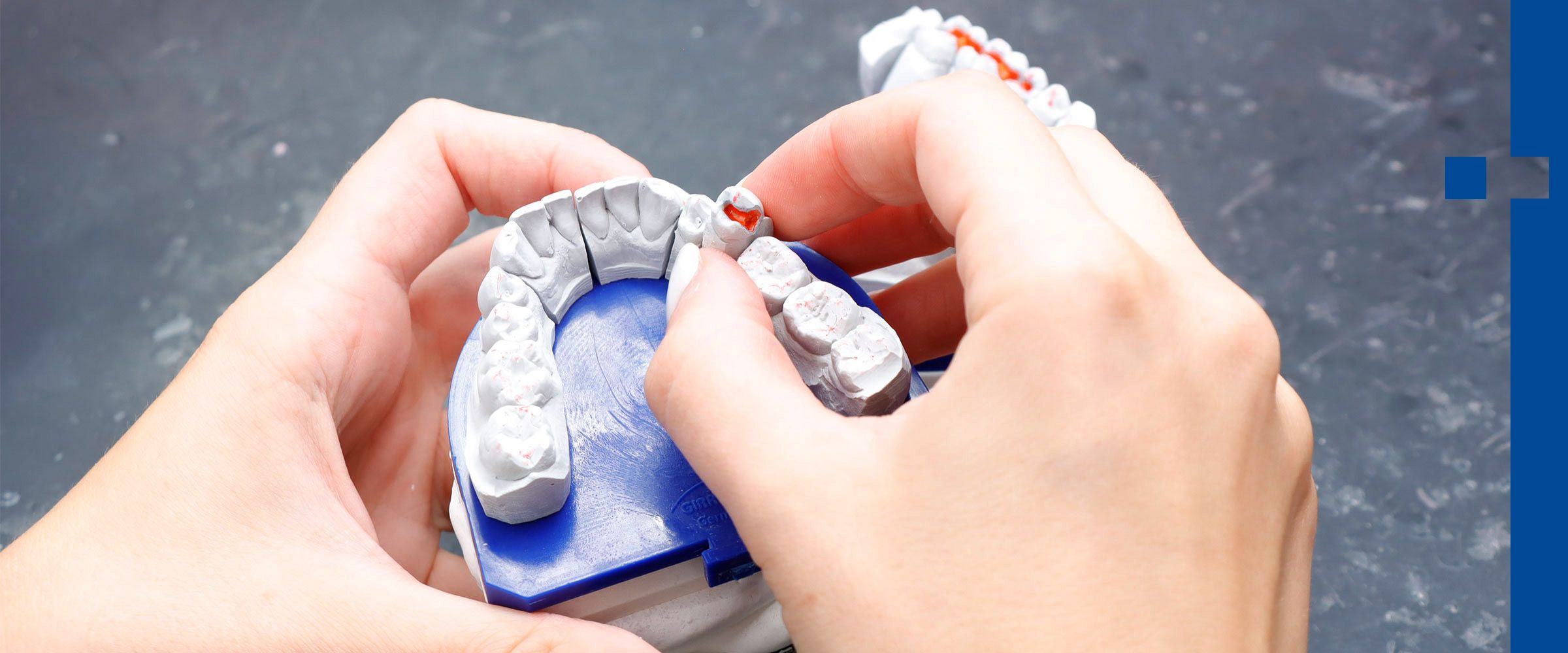 Hände bearbeiten ein Kiefermodell - Zahnersatz wird auf Platz getestet