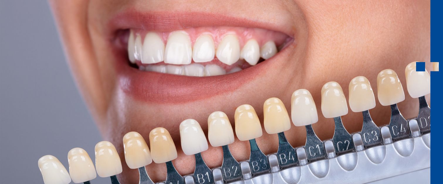 Foto: lachender Mund einer Frau mit Farbmuster zum Zahnfarbabgleich